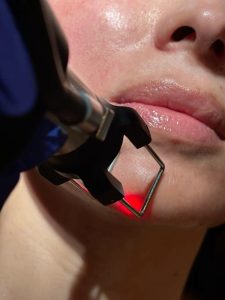 Láser CO2 en Providencia: ¿para qué sirve y cómo puede mejorar tu piel?