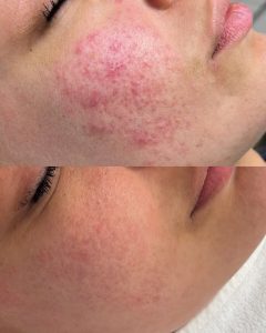 Rosácea: cómo reconocerla, por qué empeora en otoño y qué puedes hacer